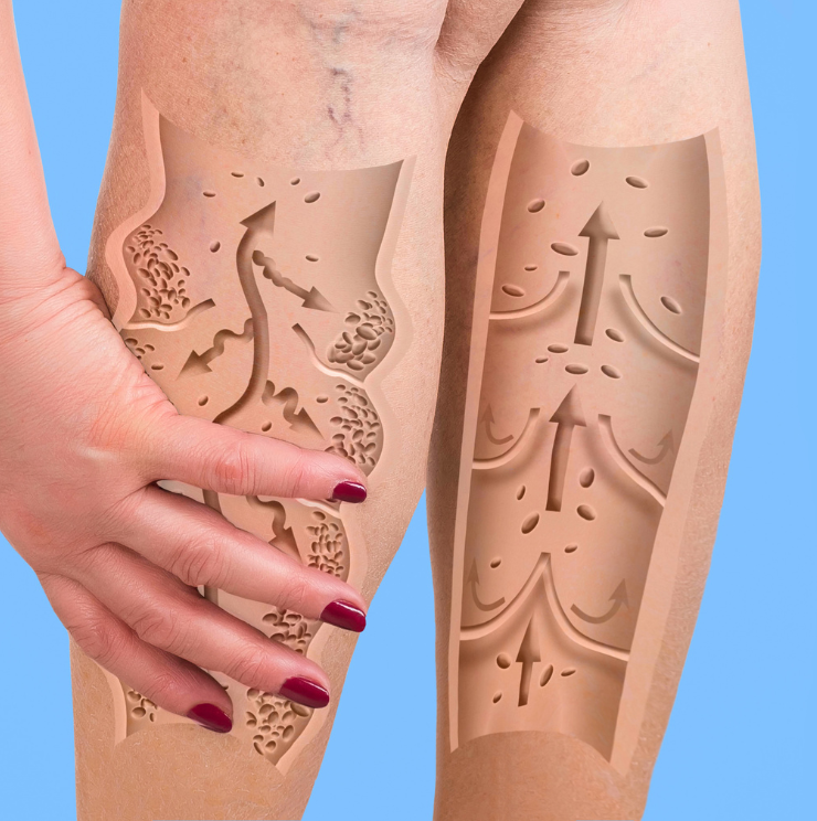 Tratamiento de varices sin cirugía. Imagen de pantorrillas con un dibujo que emula la circulación sanguínea