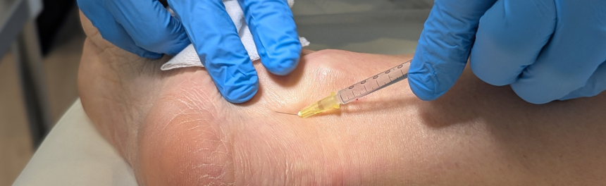Tratamiento de una variz mediante espuma esclerosante